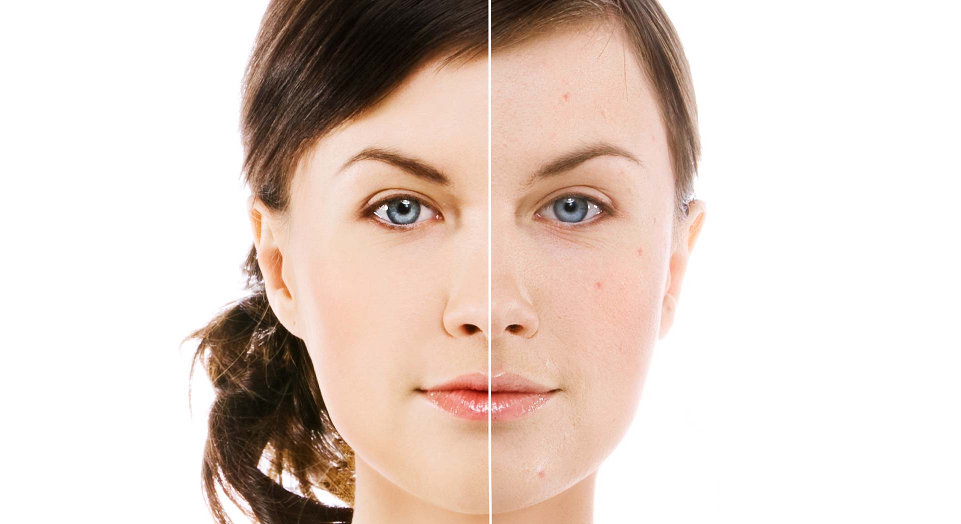 Calgary Laser Acne Removal | Facial Esthetics One